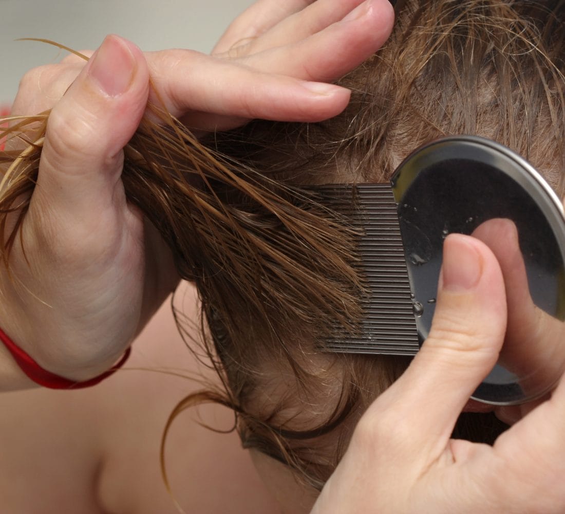 Cabello con piojos en pamplona
